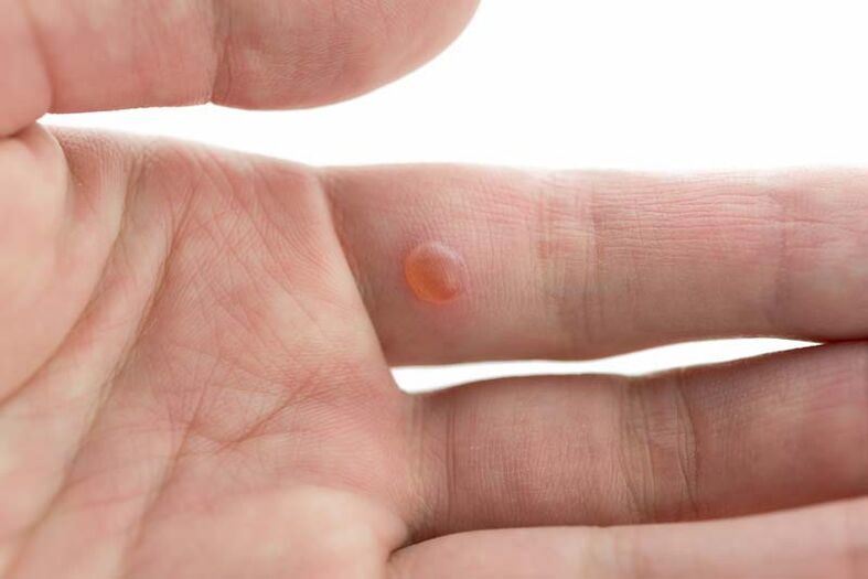 Uma verruga no dedo, da qual os remédios populares ajudam a eliminar