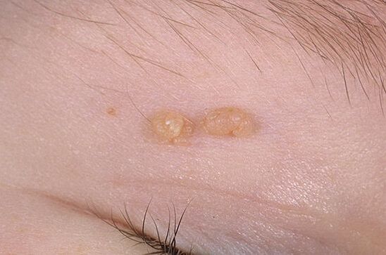 Papiloma comum