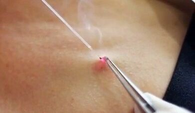 Remoção de Papilloma no corpo com um laser