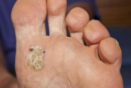 As razões para o aparecimento de uma verruga plantar