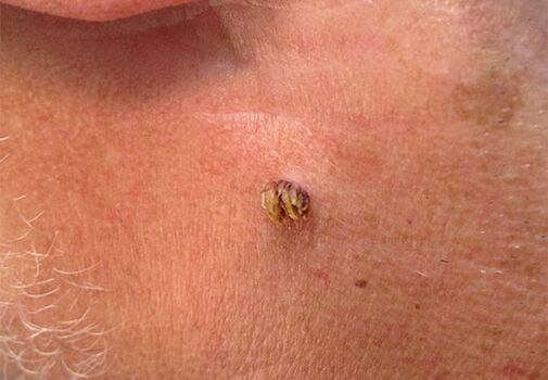 Papiloma no pescoço