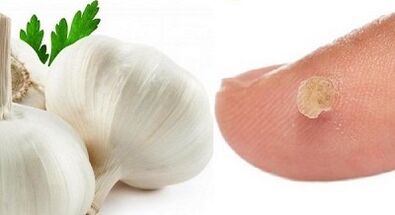 tratamento de verrugas com remédios populares