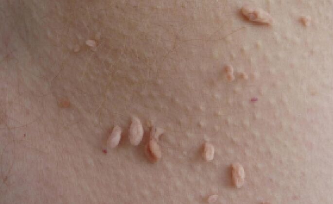 razões para o aparecimento de papilomas no corpo humano