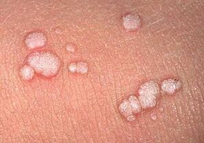 papilomas vulgares no corpo humano