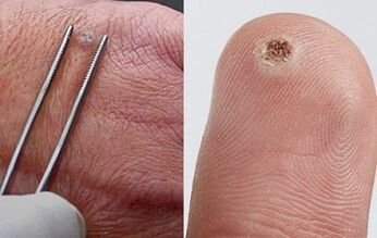 sintomas de papilomas no corpo humano