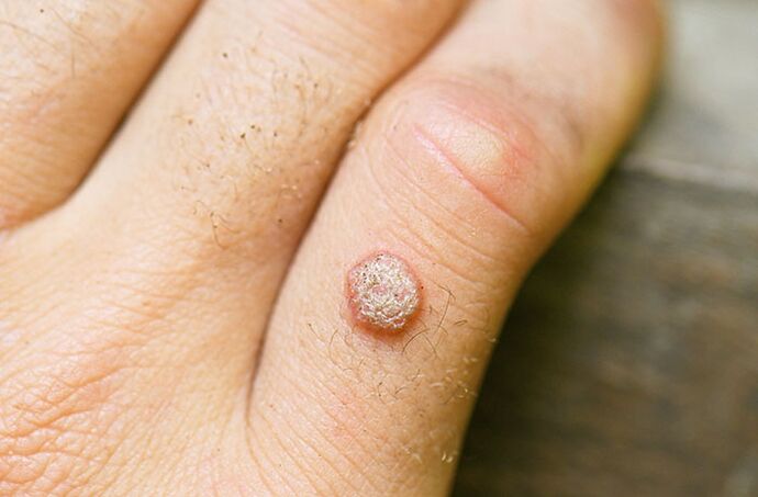 Quando infectado com HPV, uma verruga pode aparecer no braço ou em outra parte do corpo