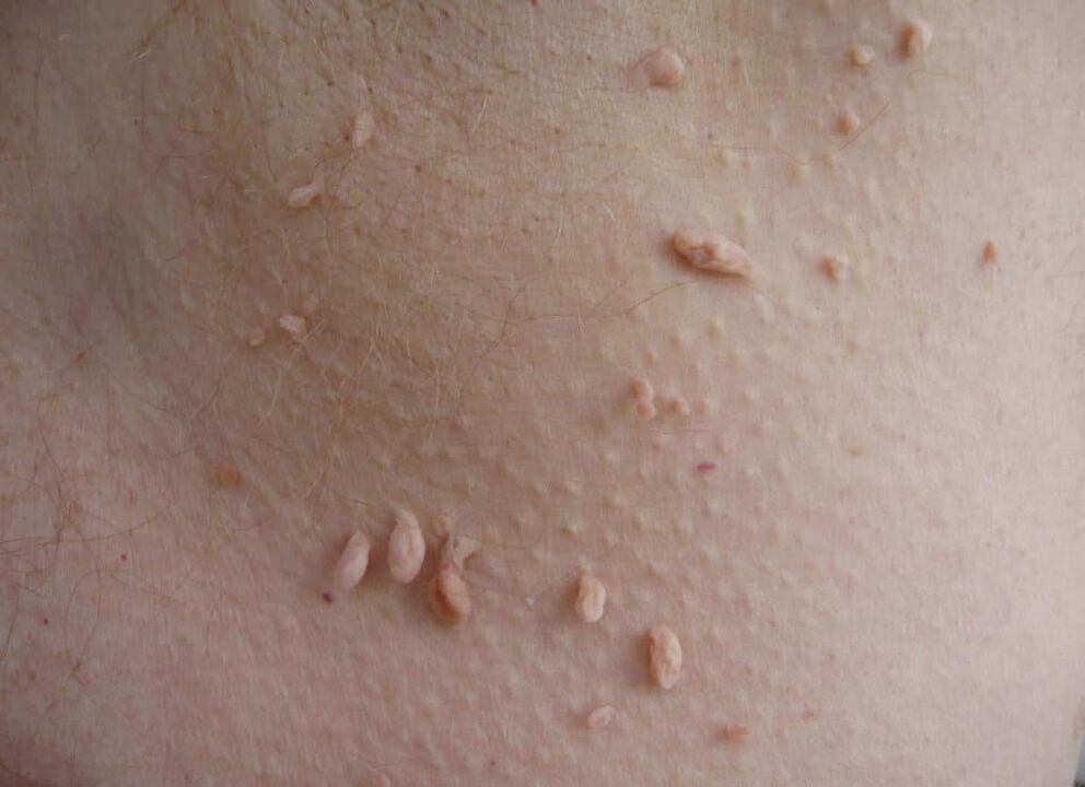 tipos de papilomas no pescoço