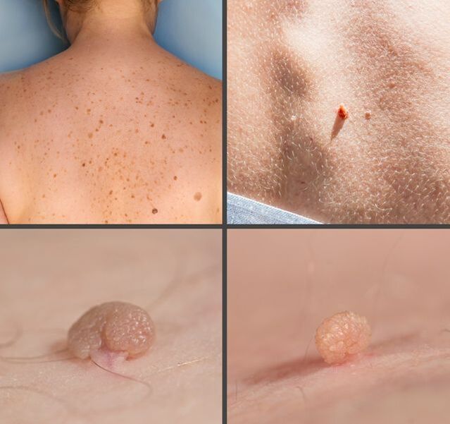 Qual é a aparência dos papilomas no corpo