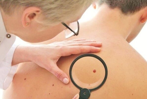 o médico determina o tipo de papiloma na pele